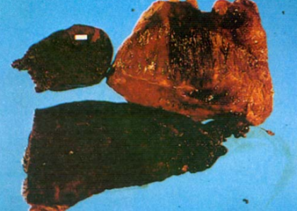 THÔNG TIN VỀ BỆNH UNG KHÍ THÁN